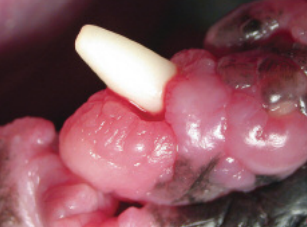 gingival hyperplasia clinicians brief gingival hyperplasia