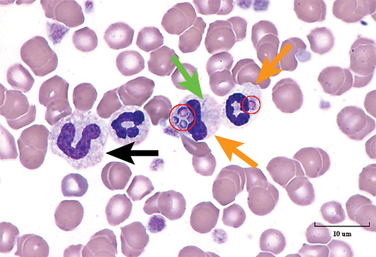Quiz: White Blood Cell Evaluation in Blood Films | Clinician's Brief