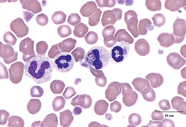Quiz: White Blood Cell Evaluation in Blood Films | Clinician's Brief