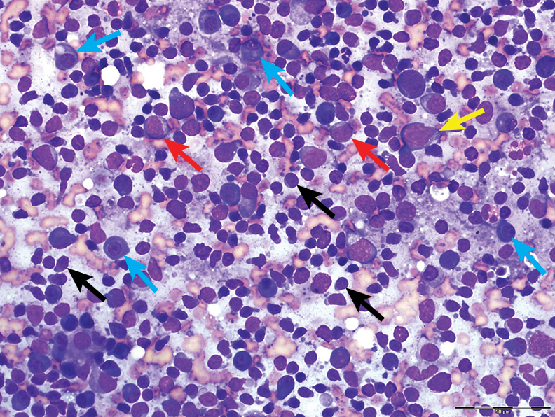 Top 5 Cytologic Findings in Aspirates of Enlarged Lymph Nodes