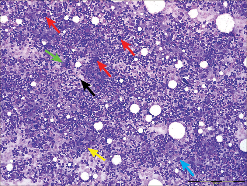 Top 5 Cytologic Findings in Aspirates of Enlarged Lymph Nodes