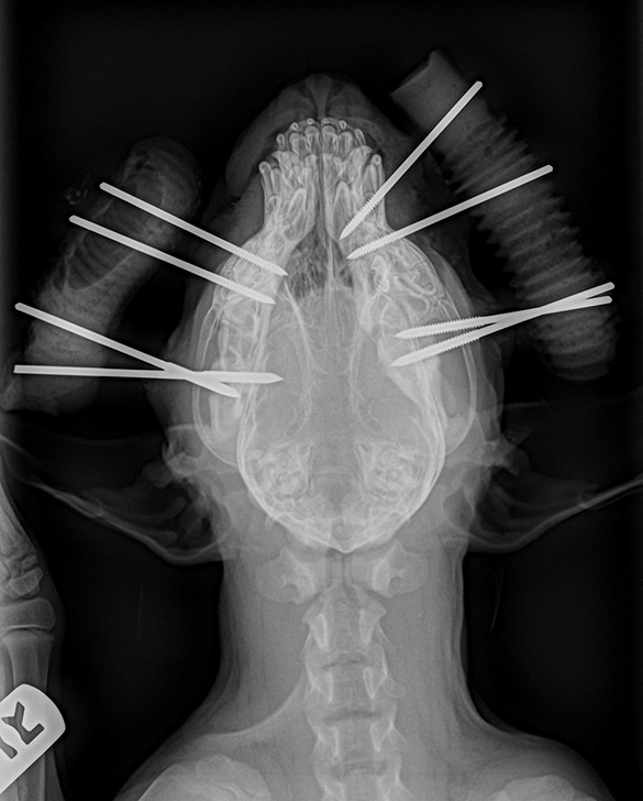 Types Of Jaw Fractures