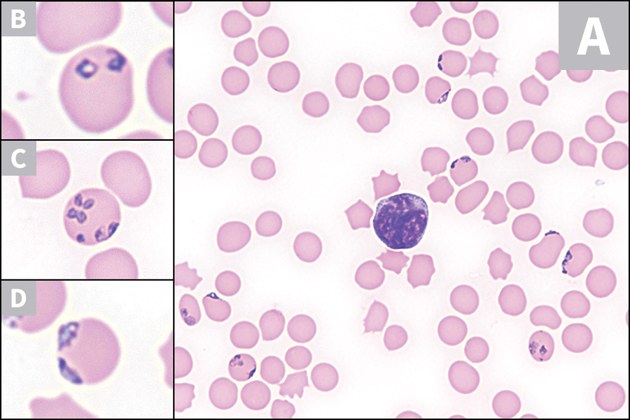 Babesiosis | Clinician's Brief