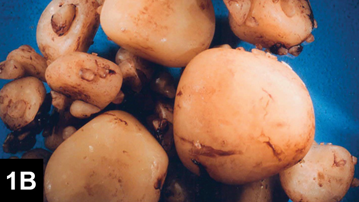 Struvite Urolithiasis | Clinician's Brief