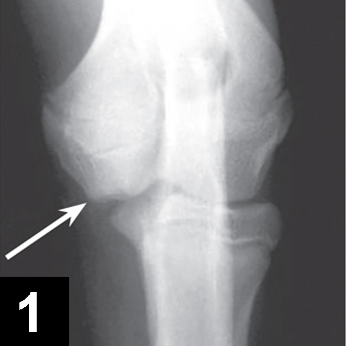 Medial Compartment Disease of the Elbow Clinician's Brief