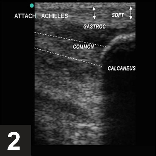Nonsurgical Management of an Achilles Tendon Strain in a Dog