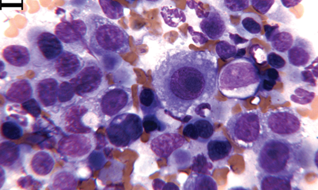 atypical transitional epithelial cells clinician s brief