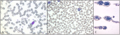 Current Thoughts on Coagulopathy Testing | Clinician's Brief