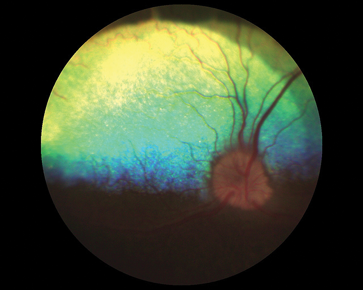 Optic Neuritis Clinician's Brief