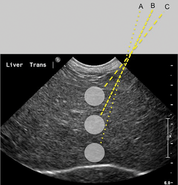FineNeedle Aspiration of the Liver Clinician's Brief