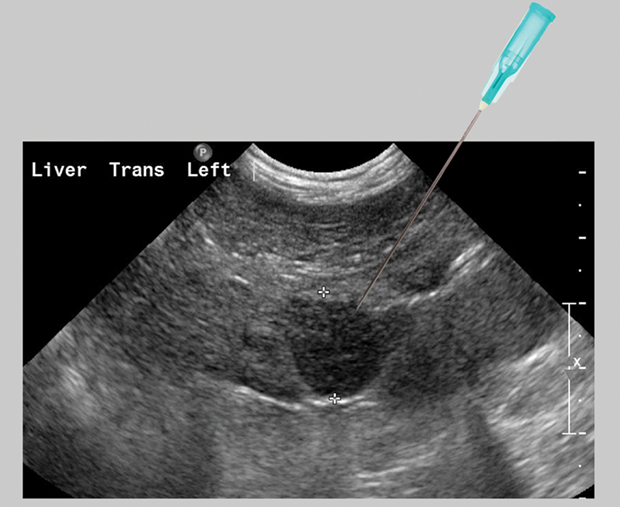 FineNeedle Aspiration of the Liver Clinician's Brief