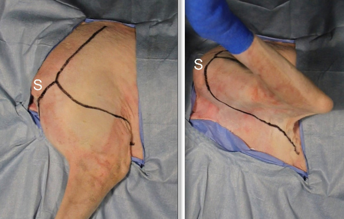 Step-by-Step Forelimb Amputation | Veterinary Team Brief