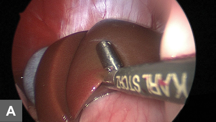 Open & Laparoscopic Liver Biopsy | Clinician's Brief