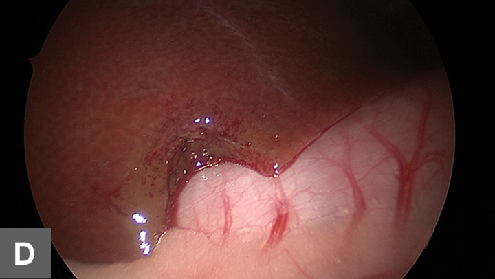 Open & Laparoscopic Liver Biopsy | Clinician's Brief