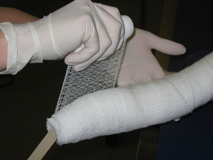 Effective Casting Techniques Clinician's Brief