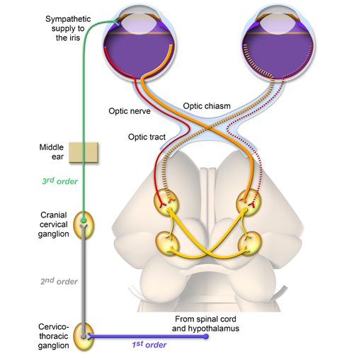 Image Gallery Anisocoria Clinician's Brief