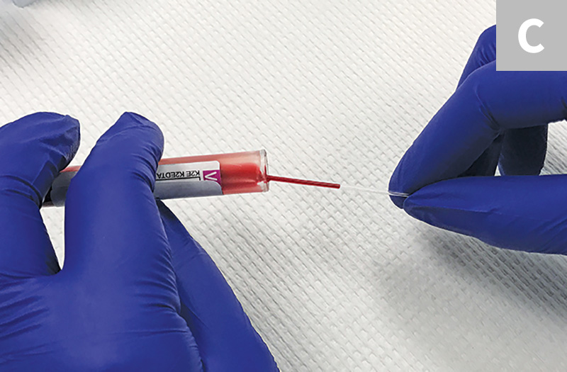 Blood Smear Preparation Clinician's Brief