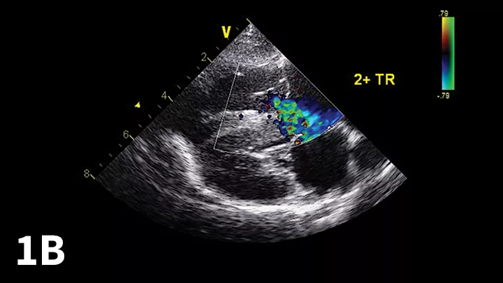 Echocardiographic Doppler study documenting high tricuspid regurgitant velocity consistent with pulmonary hypertension. The modified Bernoulli equation [change in pressure = 4 (regurgitant velocity)2] may be used to estimate the systolic PAP. In the example shown, the tricuspid regurgitant velocity is 4.1 m/sec; thus, estimated PAP is 67 mm Hg.
