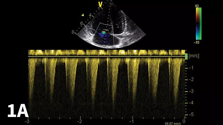 Echocardiographic Doppler study documenting high tricuspid regurgitant velocity consistent with pulmonary hypertension. The modified Bernoulli equation [change in pressure = 4 (regurgitant velocity)2] may be used to estimate the systolic PAP. In the example shown, the tricuspid regurgitant velocity is 4.1 m/sec; thus, estimated PAP is 67 mm Hg.
