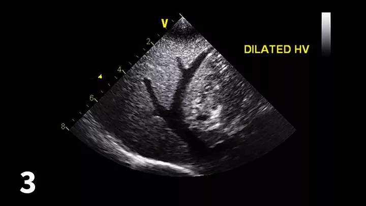 Abdominal ultrasound image documenting enlarged hepatic vessels consistent with right-sided heart failure.
