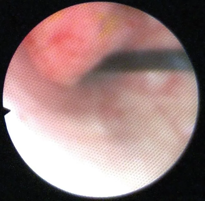 Polypoid Cystitis Causing Recurrent Hematuria in a Dog Clinician's Brief