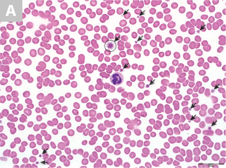 Blood Smear Platelet Evaluation & Interpretation Clinician's Brief